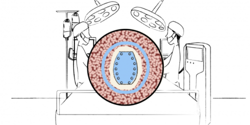 1ère implantation d’une céramique (Céramil) chargée en antibiotique 3