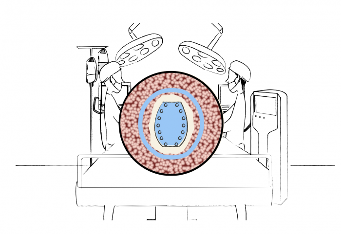 1ère implantation d’une céramique (Céramil) chargée en antibiotique 3